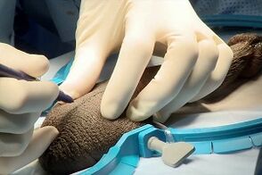 Cerrahi penis büyütme için tatarcık kesisi